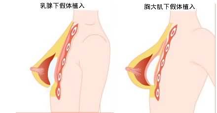 Yestar 韩式无痕动感丰胸的手术方法