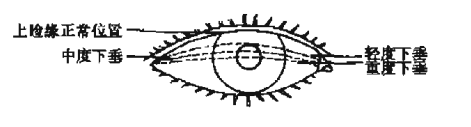 上睑下垂示意图