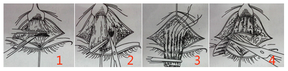 提上睑肌缩短过程