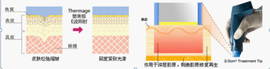 除皱原理