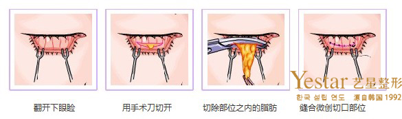 结膜入路去眼袋