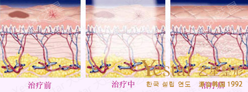 激光点痣原理图