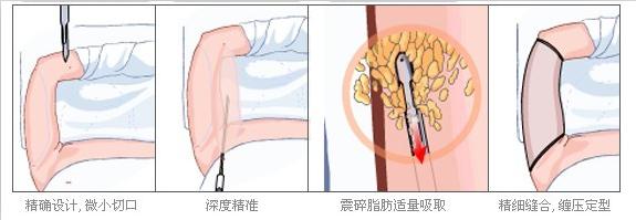 男性胸部吸脂贵不贵