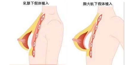 隆胸手术