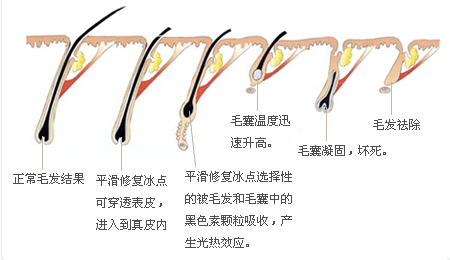 冰点脱毛