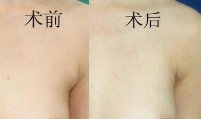 上海艺星副乳切除