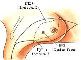 乳头缩小整形手术后效果怎么样