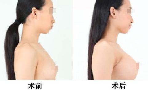 乳房再造术是否会有危险