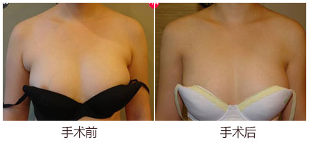 女生有副乳可以手术解决吗