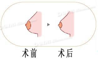 上海乳晕漂红效果理想吗