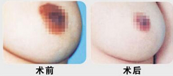 上海整形乳晕缩小怎么样