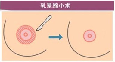 乳晕缩小要多少钱