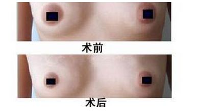 上海乳晕整形哪里好