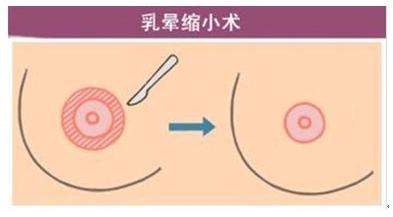 上海乳晕整形需要多少钱