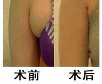 /副乳是怎么产生的