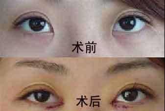 上海开眼角手术详解