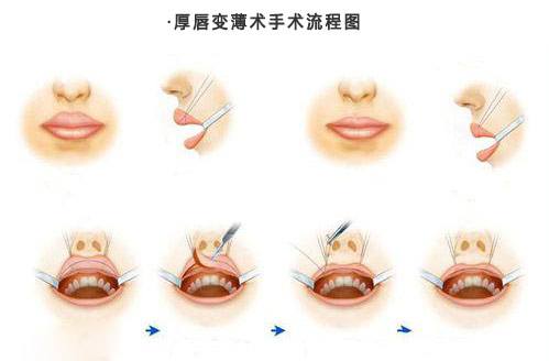 艺星厚唇变薄术流程图