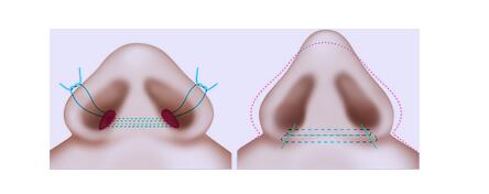 塌鼻子怎么矫正