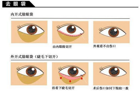 手术去眼袋