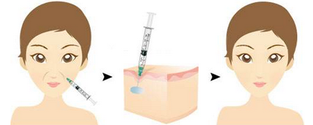 玻尿酸消除法令纹