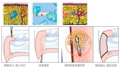 上海艺星手臂吸脂过程