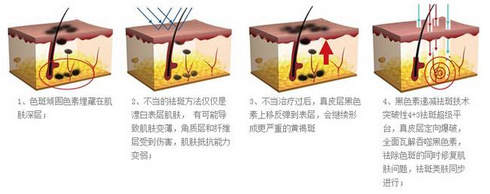 激光祛斑