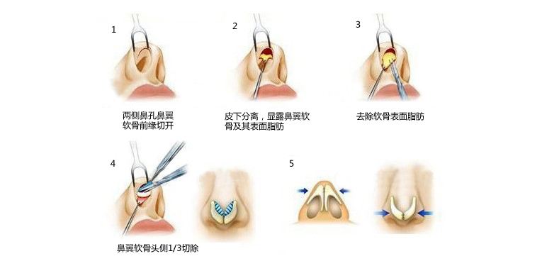 上海做鼻尖整形要多少钱