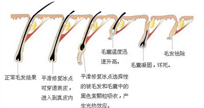 激光脱毛原理