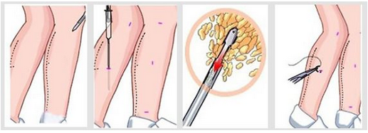 腿部吸脂手术过程
