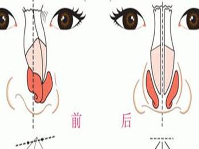 驼峰鼻矫正手术价格多少