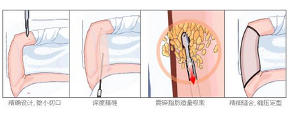 吸脂瘦手臂