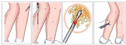 小腿吸脂手术原理