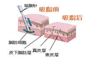 吸脂减肥