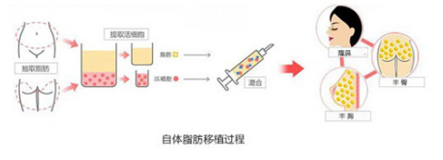 自体脂肪填充