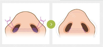 鼻翼缩小术