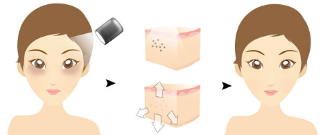 激光治疗黑眼圈的原理