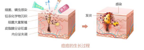 痘痘生长过程