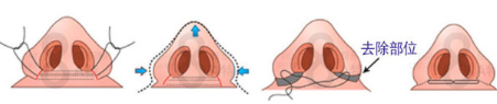 鼻翼缩小术