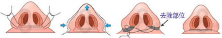 鼻翼缩小