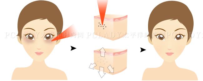 吸脂能够去眼袋吗