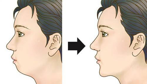 鼻部整形后遗症避免方法