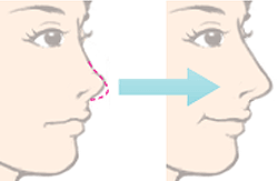 鼻尖整形的优势是什么
