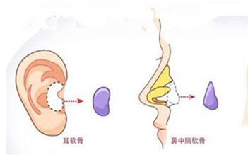 鼻小柱延长用哪种材料比较好