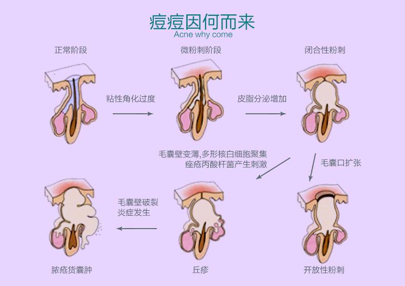 激光去痘坑的治疗费用高吗