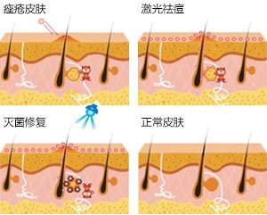 痤疮是什么原因引起的