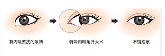 开内眼角和开外角手术的适应人群