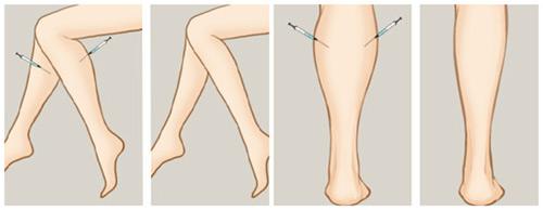 小腿吸脂的特点有哪些