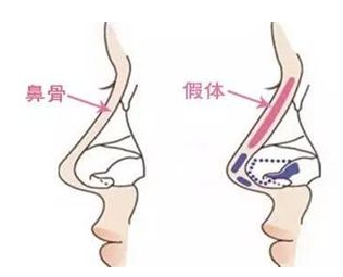 艺星隆鼻手术原理