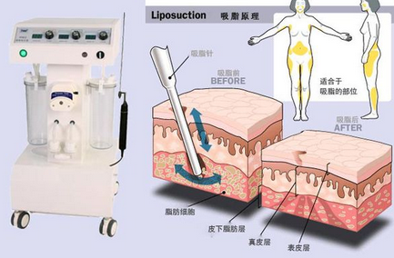 艺星吸脂原理