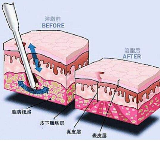 上海手臂吸脂效果